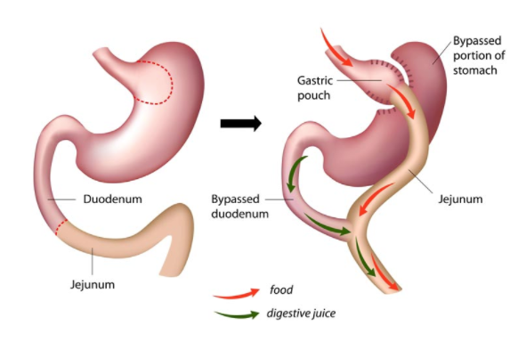 Digestive system showing the effects of bypass surgery