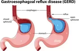 Gastroesophageal Reflux Disease 
