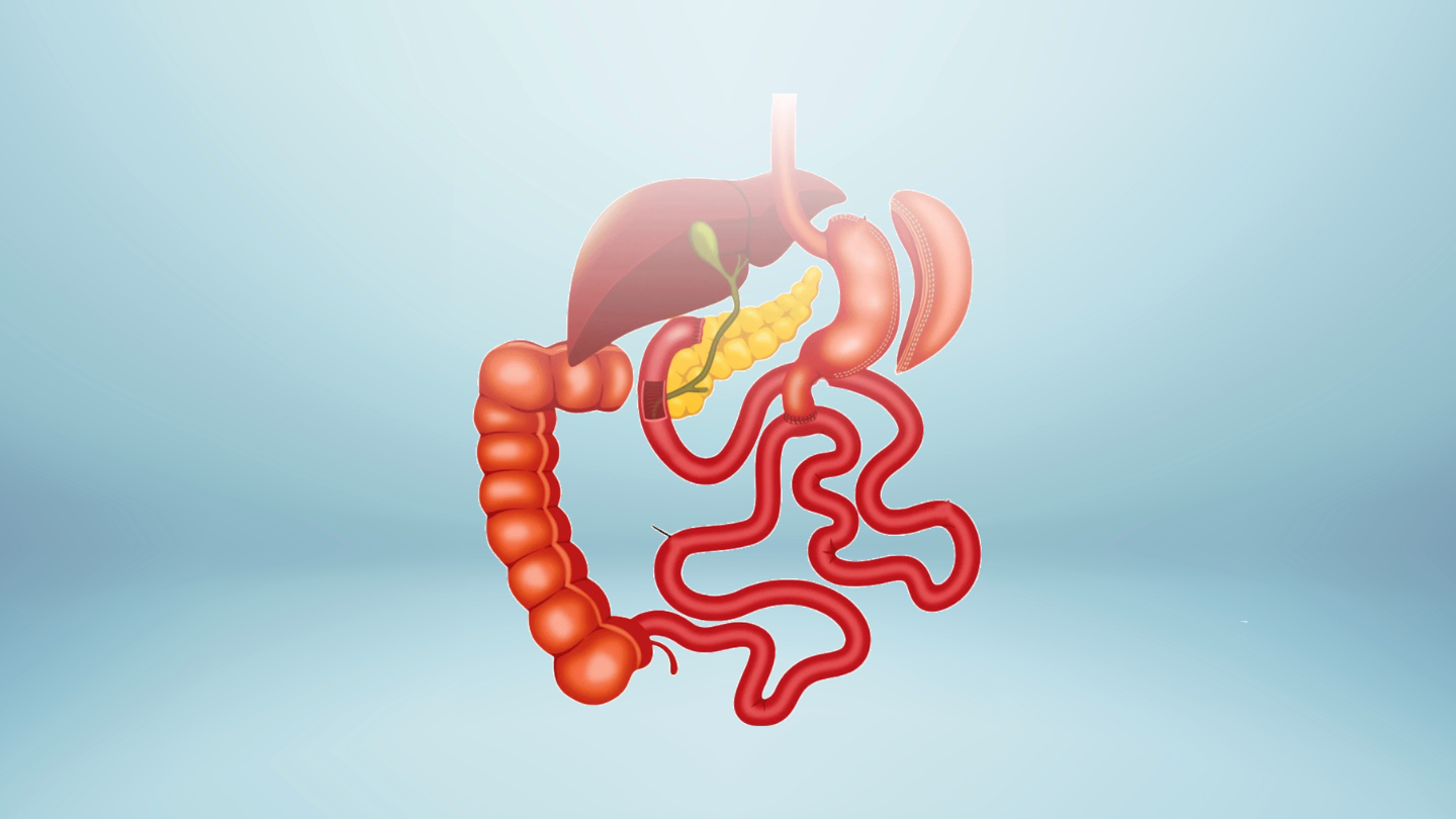 Duodenal Switch vs. Gastric Bypass: What’s the Difference?
