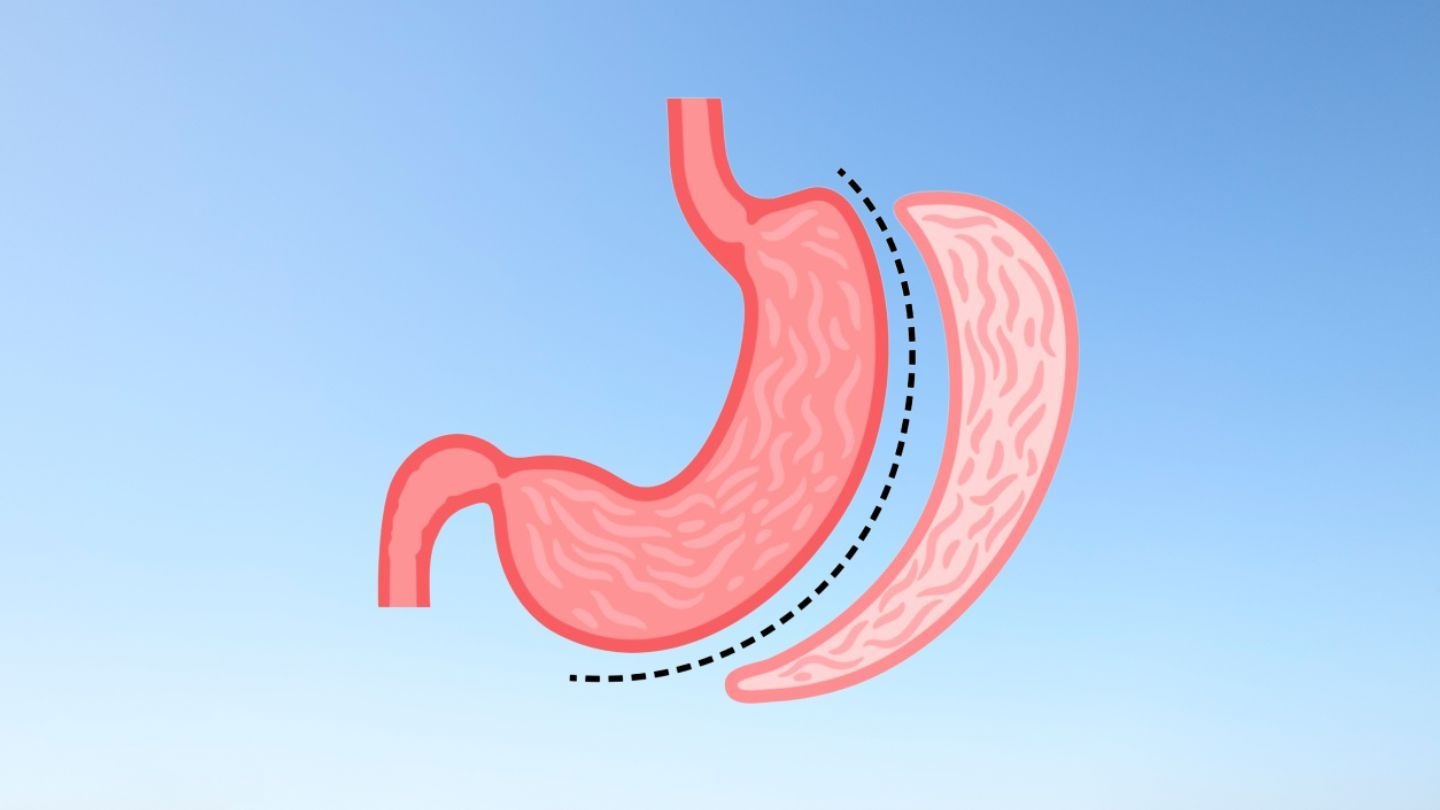 Why Baltimore Is Leading the Nation in Sleeve Gastrectomy Success?