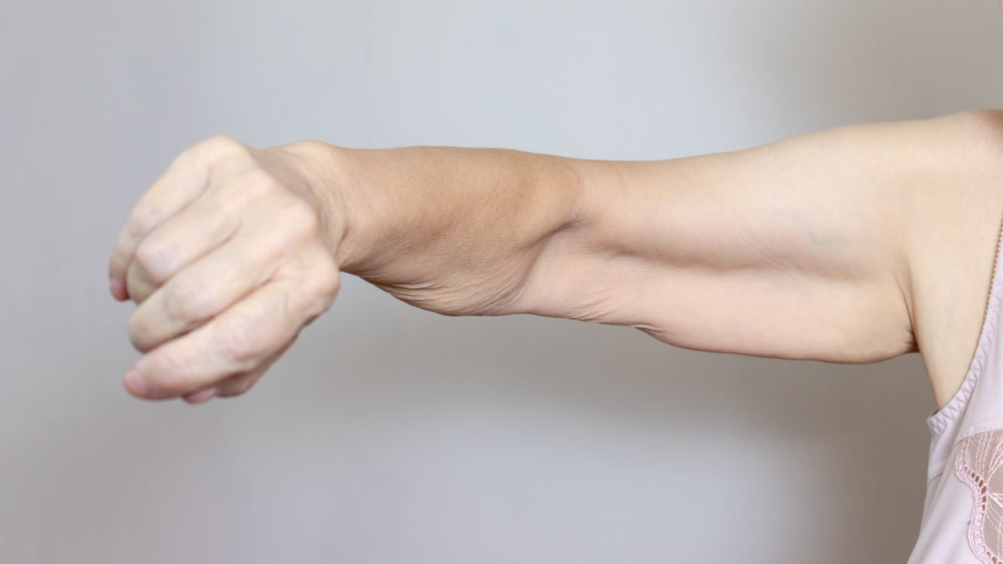 Can Loose Skin After Weight Loss Surgery Be Prevented?