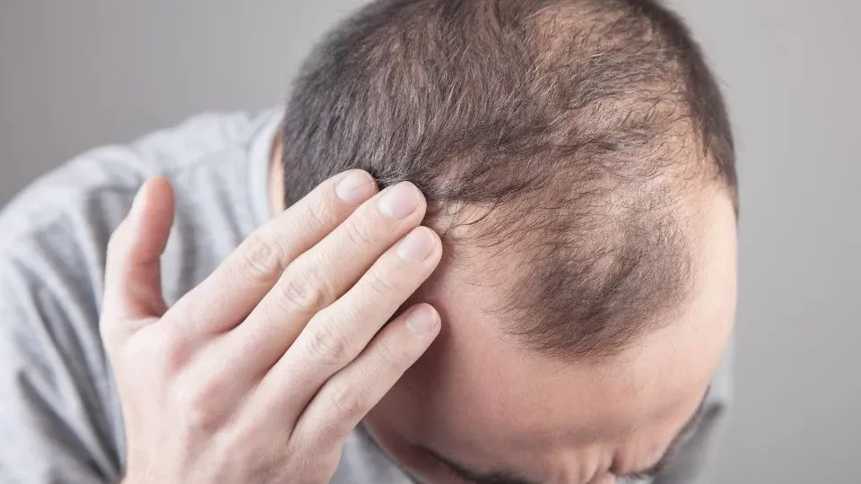 Man Experiencing Hair Loss