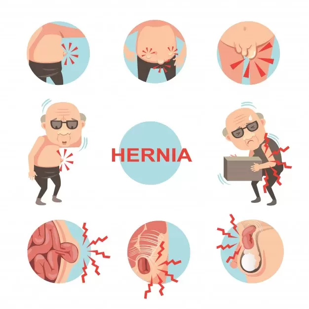 Umbilical Hernia Questions - 5 Most Frequently Asked Questions