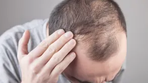 Man Experiencing Hair Loss