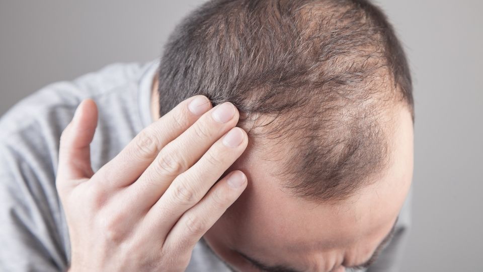 Hair Loss After Bariatric Surgery: What You Need to Know