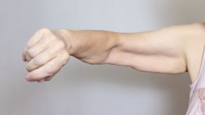 Can Loose Skin After Weight Loss Surgery Be Prevented?