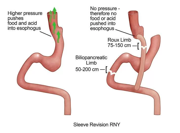 Representation of Gastric Sleeve Revision