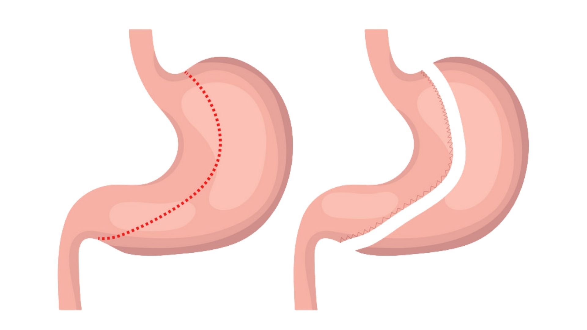 Can the Stomach Grow Back After Having Gastric Sleeve Surgery?