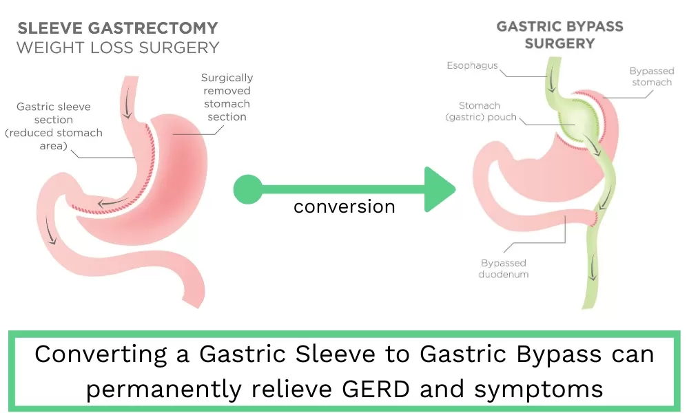 Converting Sleeve Gastrectomy To Gastric Bypass