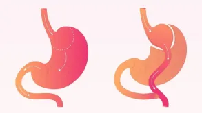 Gastric Bypass Surgery Diagram Showing Stomach Alterations