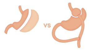 Comparing Gastric Sleeve vs. Gastric Bypass