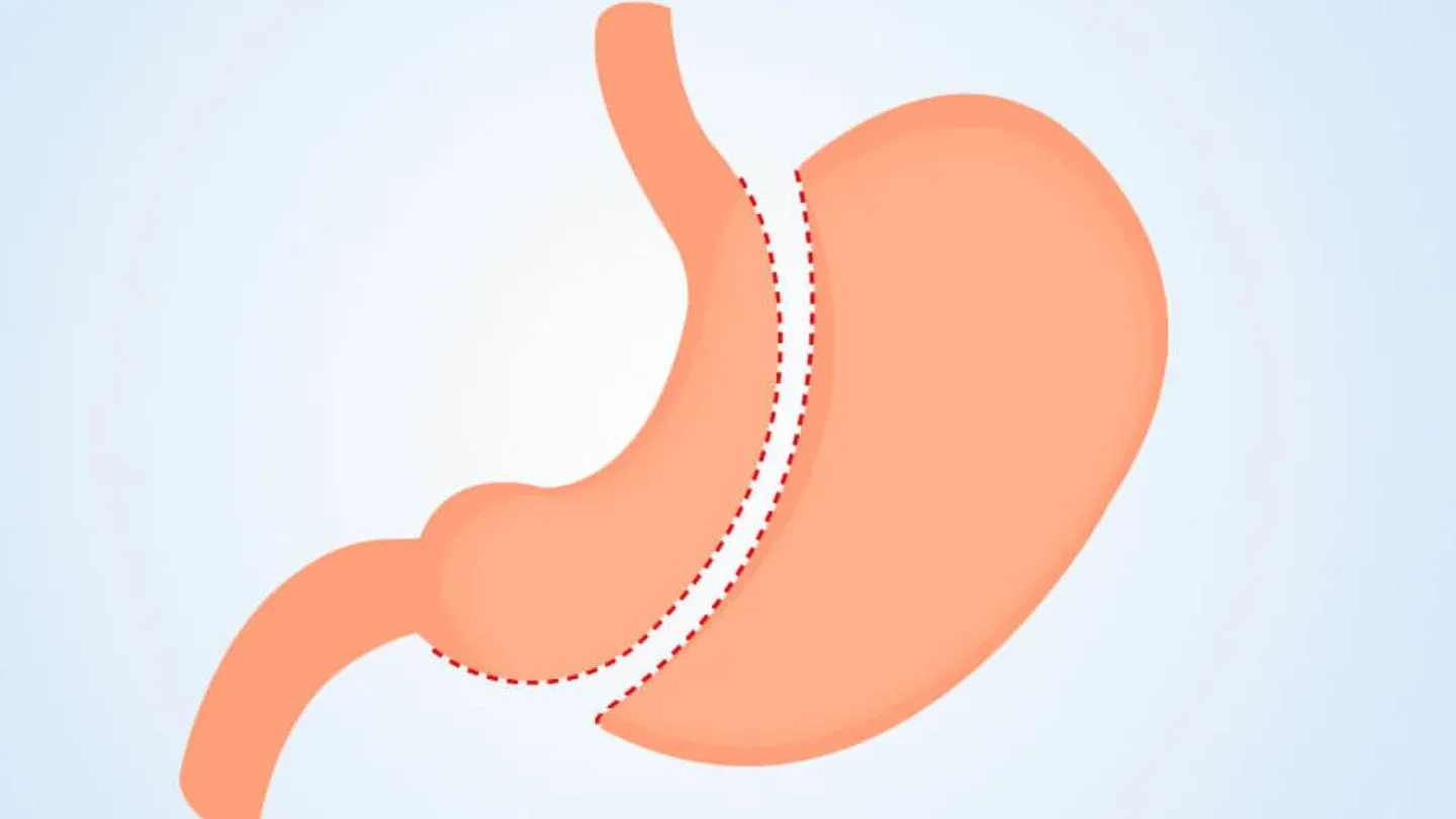 Diagram Of Stomach After Sleeve Gastrectomy Procedure