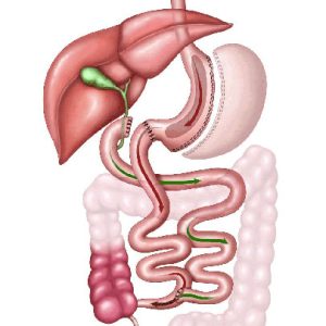 Duodenal Switch Diagram