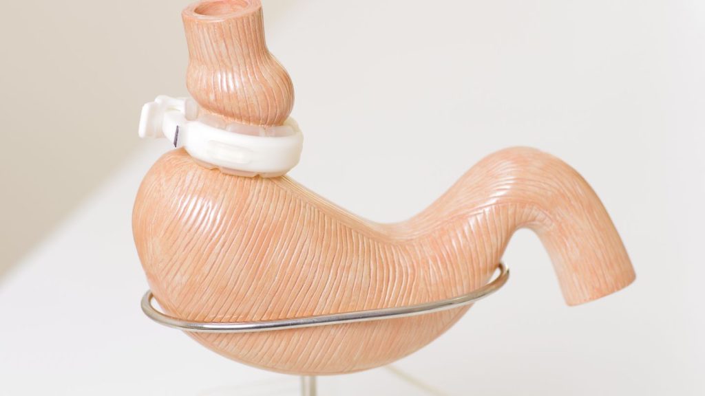 Stomach Model With Gastric Band
