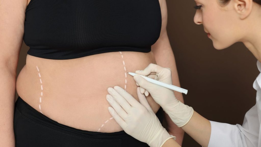 Surgeon Marking Patient's Abdomen
