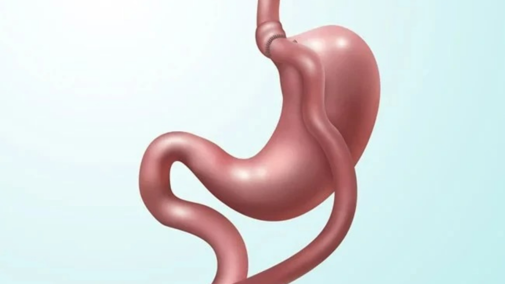 Duodenal Switch and Gastric Bypass: Which One Is Right for You?