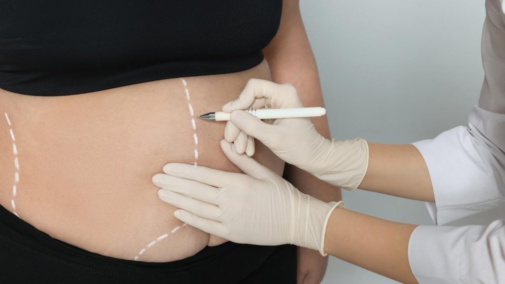 Doctor Marking Body for Fat Reduction Surgery
