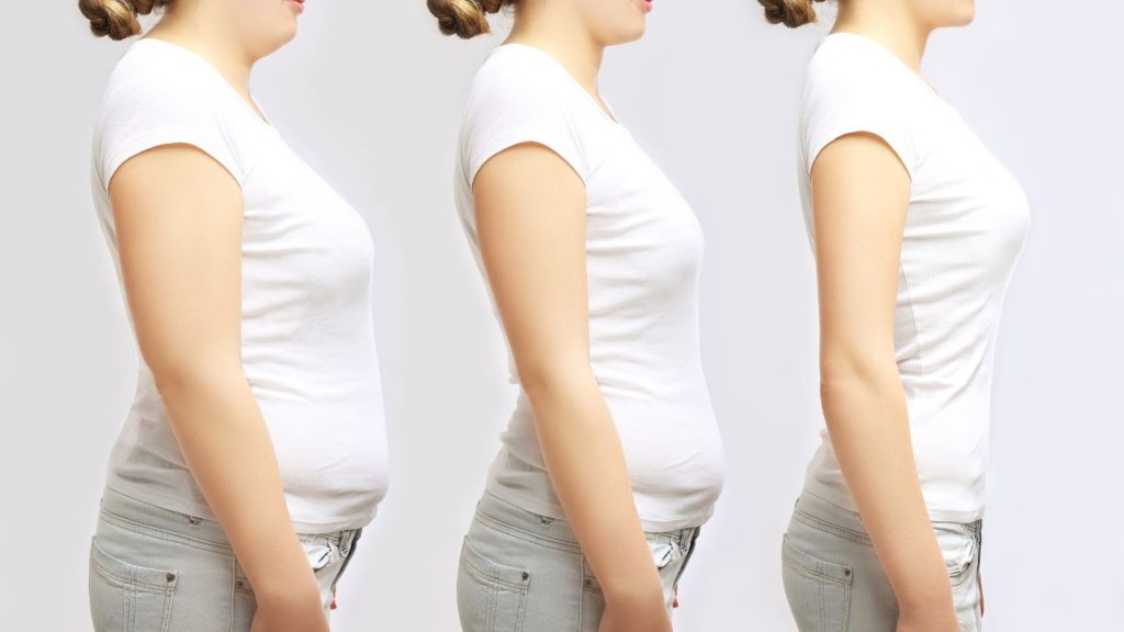 What to Expect: Timeline of Skin Changes After Gastric Sleeve